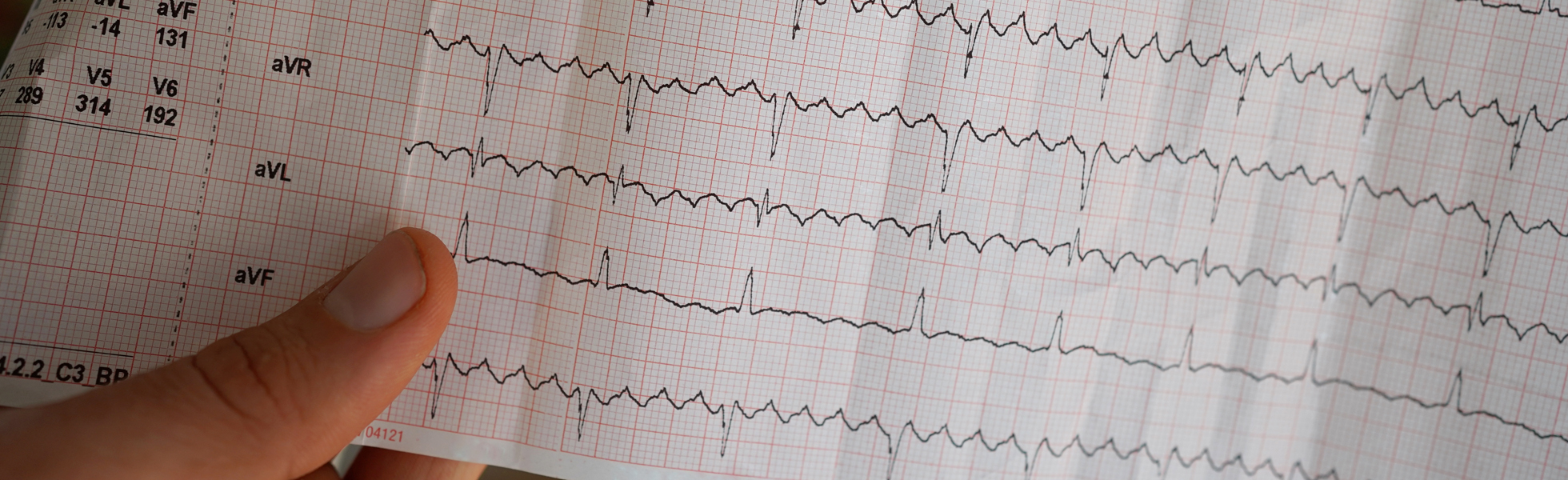 Atrial fibrillation